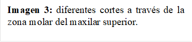 Imagen 3: diferentes cortes a través de la zona molar del maxilar superior.   
