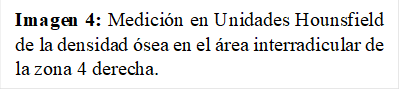 Imagen 4: Medición en Unidades Hounsfield de la densidad ósea en el área interradicular de la zona 4 derecha. 